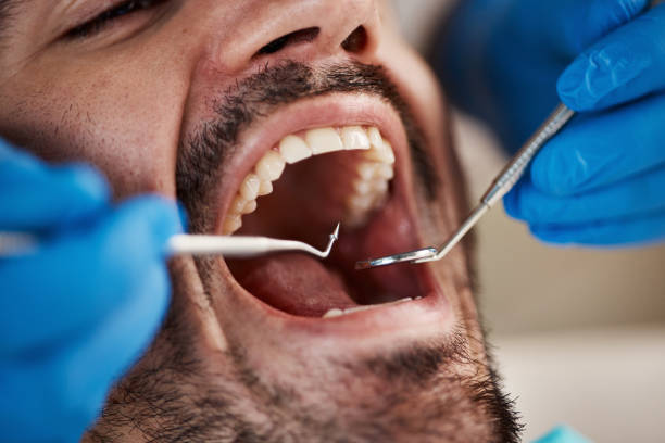 Best Chipped Tooth Repair Near Me  in Elm Creek, NE